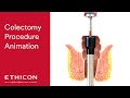Colectomy Using Purse String Technique | Ethicon