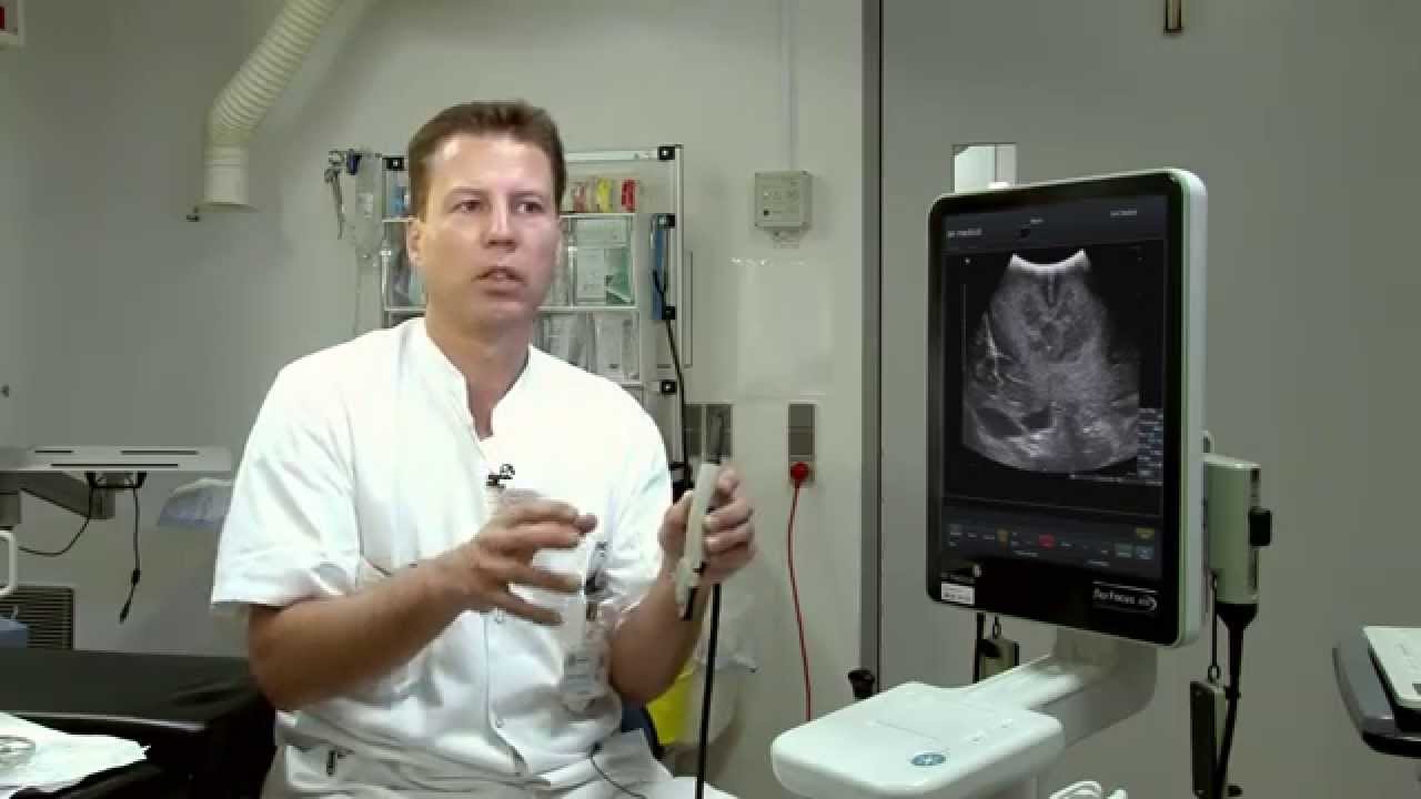 Intraoperative ultrasound for craniotomies: burr hole and craniotomy trandsucers and puncture guides