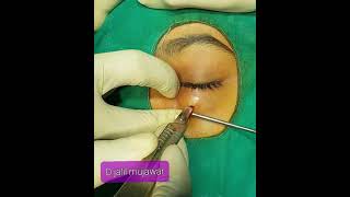 eyelid abscess drainage.Dr jalil mujawar