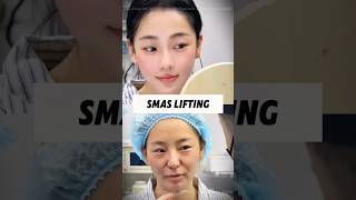 Targeted SMAS lift for jowls. #FacialLifting #facecontouring