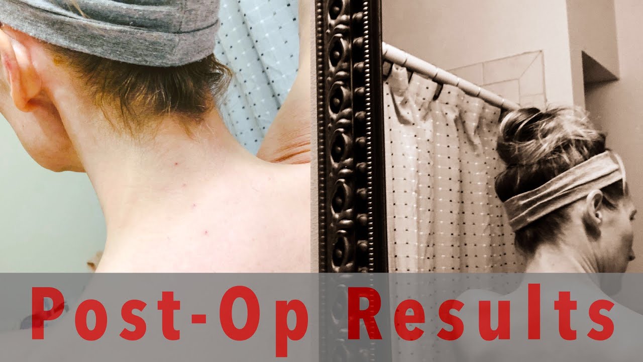 Post Facet Nerve RFA Radiofrequency Ablation Chronic Neck Pain Caused