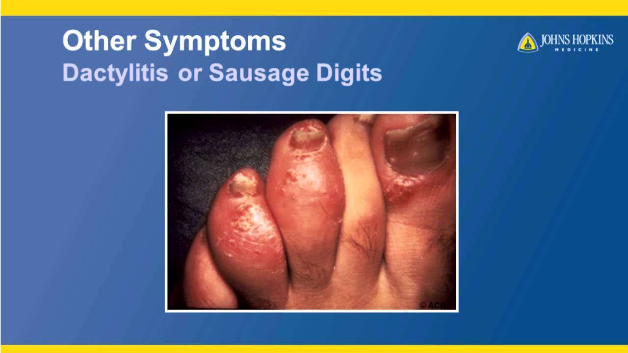 Psoriatic Arthritis : Clinical Characteristics and Diagnosis