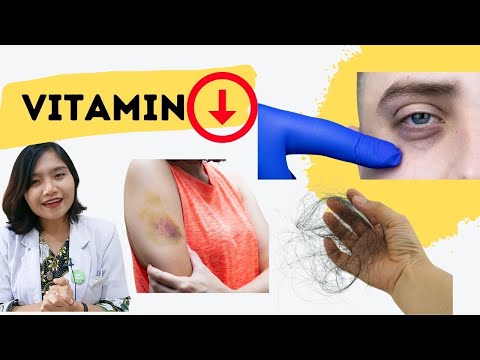 20 BODY SIGNS OF CERTAIN VITAMIN DEFICIENCY | dr.Emasuperr