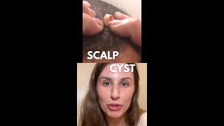 Scalp Cyst Rupture…Tiny Little Scalp Pearl