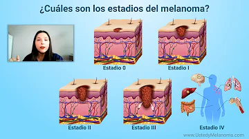 ¿Cuáles son los 5 estadios del melanoma?