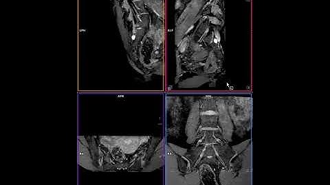 MR Lumbar Plexus - 3D DESS @ 1.5T