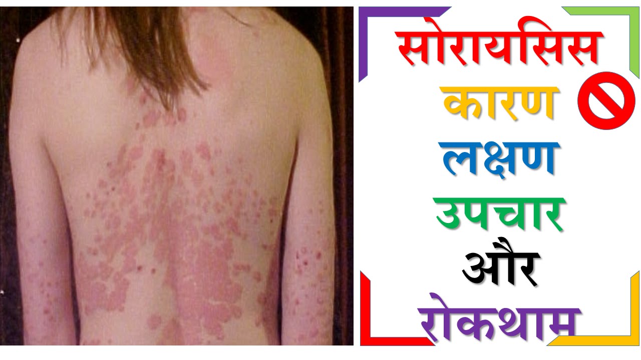 Psoriasis hindi jelentése