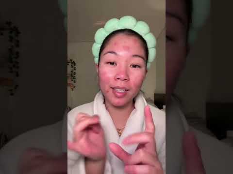 Loan Nguyen's 2021 Blackhead Removal:  It's More Than Just Popping