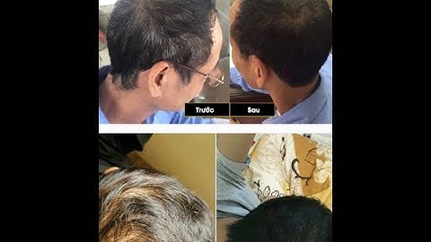 Rụng Tóc Hói Đầu Dứt Điểm chỉ với 1 liệu trình . 100% Tóc Mọc tua tủa như Nấm .Gọi ngay 0856.502.055