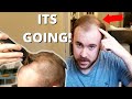 Balding At 23 Years Old - I'm Shaving It Off!