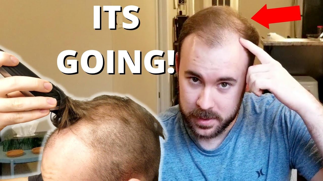 Balding At 23 BUT I'm About To Change My Life! - YouTube