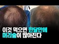 이 음식을 먹으면 한달만에 머리숱 많아진다 탈모에 좋은 식품