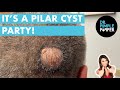 It's a Pilar Cyst Party!