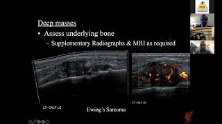 Radiological Approach to Soft Tissue Bumps and Sarcomas