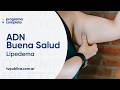 Lipedema: tratamiento - ADN Buena Salud