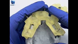 Bone Supported Pin Guide, Bone Reduction and Osteotomy Surgical Guides Explain