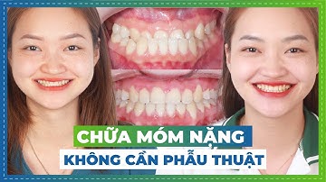HẾT MÓM SAU 2 NĂM NIỀNG RĂNG