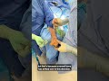 Where Bunions Start — And How Lapiplasty® Fixes the Root Cause