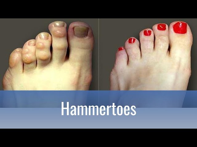 How to Use 3pp Toe Loops to Relieve Hammertoes, Overlapping Toes and More -  3-Point Products 