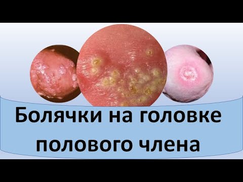 Болячки на головке полового члена