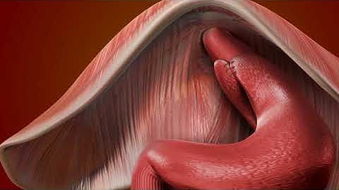 Fundoplicatie