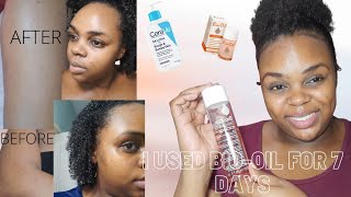 I Used Bio-Oil for 7 Days on my ENTIRE Body| Pros & Cons , Updated Skincare Routine , Acne Update