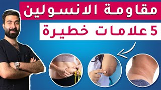 علامات مقاومة الانسولين ( الاسباب + العلاج ) | تعرف على هذه الاعراض قبل فوات الأوان !