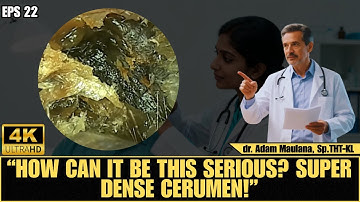 Severely Blocked Ear! Here’s What Happens When You Clean Your Ears the Wrong Way