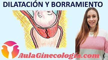 ¿Es doloroso cuando se dilata el cuello uterino?