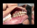 Best dental clinic in chennai  dental implant cost in chennai  senthil dental care sdc