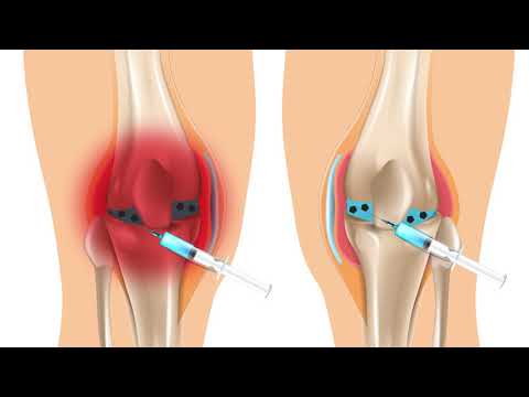 Synovial fluid biomarkers give a glimpse at the intra-articular environment after a meniscal injury