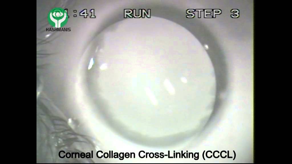 Corneal Collagen Cross Linking (CxL) - YouTube