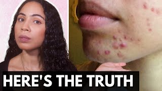 The Reason Why Your Acne Breakouts Won&#39;t Go Away For Good