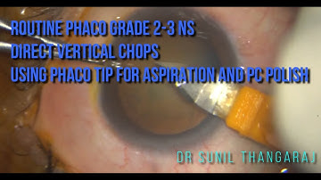 Routine phaco using direct vertical chops and phaco tip for cortical aspiration and PC polish