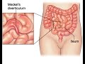 Meckel Diverticulum