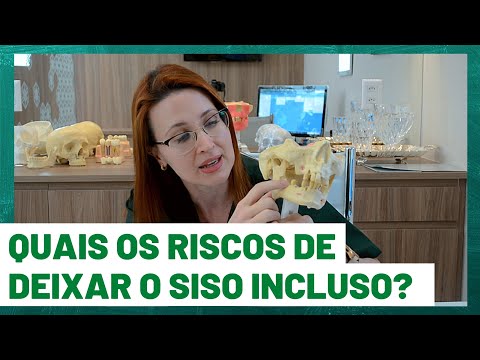 Vídeo: Dente Do Siso: Por Que é Necessário - Visão Alternativa