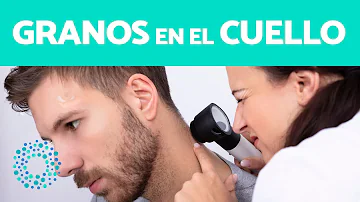 ¿Qué causa el acné en el cuello?