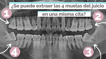 ¿Se puede pedir que te duerman para extraerte las muelas del juicio?