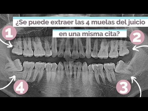 Video: ¿Puedo sacar todas las muelas del juicio a la vez?