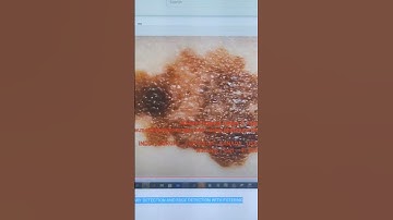 SKIN LESION IMAGE SEGMENTATION BOUNDARY DETECTION AND EDGE DETECTION WITH FILTERING