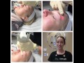FX Fractional Laser Resurfacing For The Skin Around The Eyes 