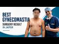 Best Gynecomastia Surgery in Jaipur | Male Breast Reduction Surgery | Dr. Deepesh Goyal
