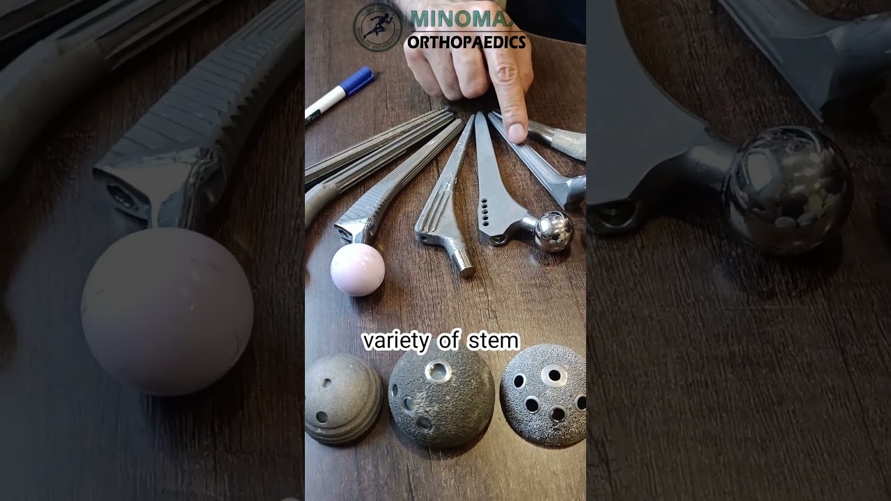 Best Implant for Hip Replacement : Part 1