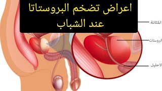 طريقة علاج تضخم البروستاتا بالاعشاب الطبيعية 0657890401