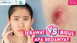 Perbedaan Jerawat dan Bisul di Wajah