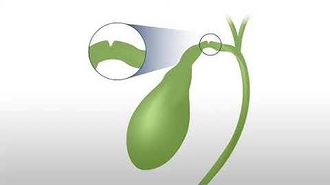 Arrow™ percutaneous laparoscopic cholangiography set with Arrow-Karlan™ balloon catheter In-service