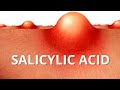 Here's WHY Salicylic Acid is Best For ACNE
