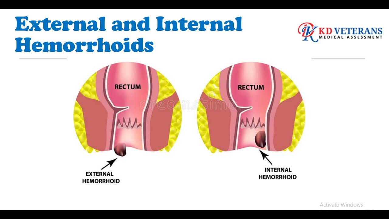 External and Internal Hemorrhoids K&D Veterans Medical Assessment VA Disability Benefits