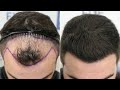 FUE Hair Transplant (2593 Grafts NW III A) By Dr Juan Couto - FUEXPERT CLINIC, Madrid, Spain