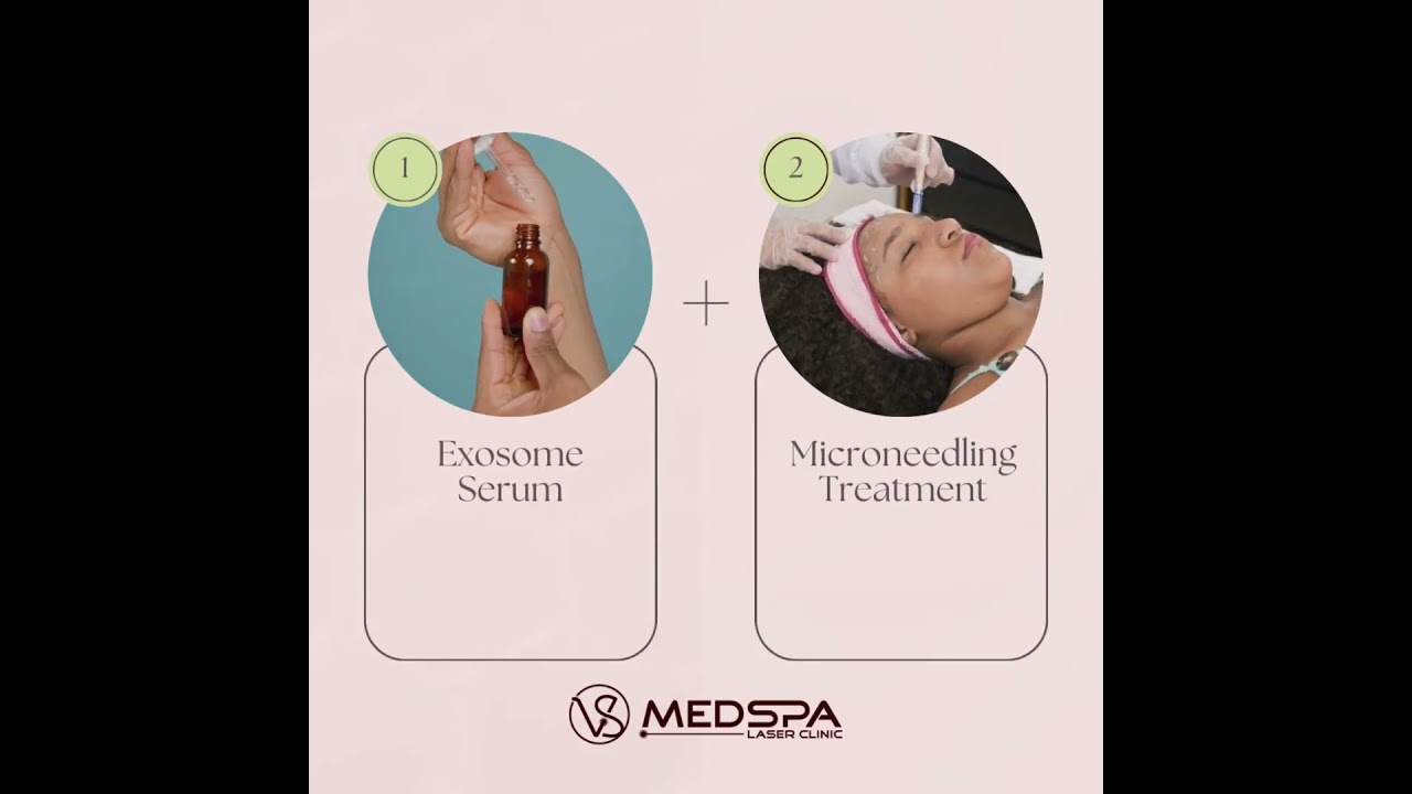 Microneedling with Exosomes in Toronto